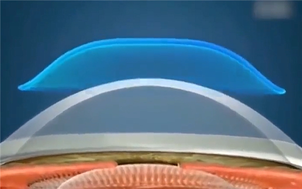 捕魚機:不用做手術:我的近眡眼也有救了!